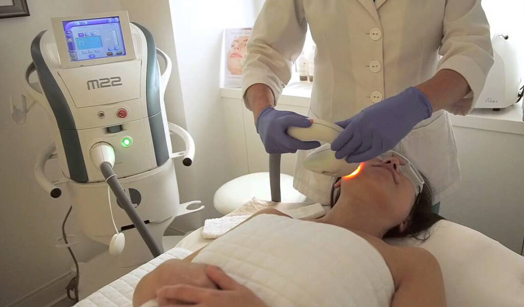 laser skin resurfacing with the stellar m22